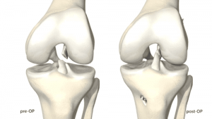 Fisioterapia en Lesiones de LCA