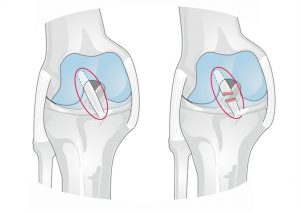 fisioterapia en abordaje lca