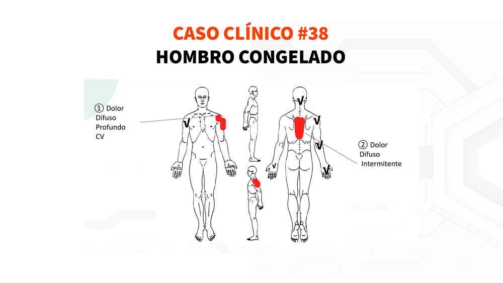 38 Hombro congelado