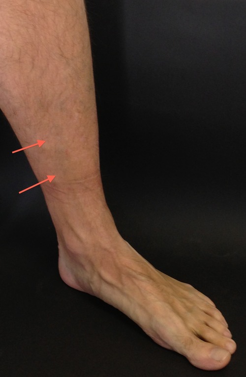 Síndrome de Estrés Tibial